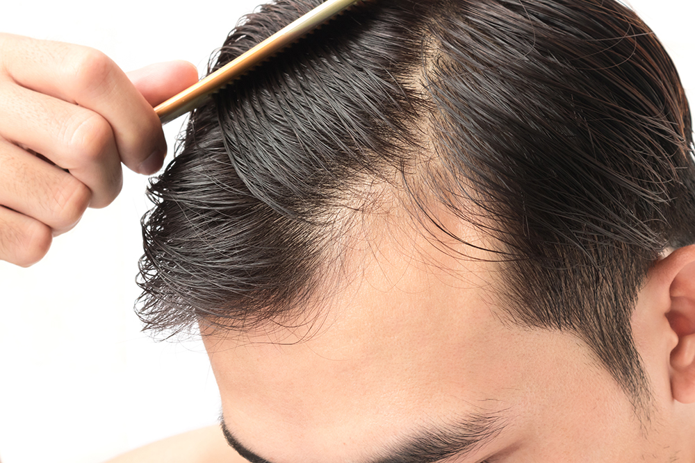 Noticing Male Pattern Baldness? What to Consider Doing