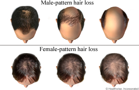 Noticing Male Pattern Baldness? What to Consider Doing